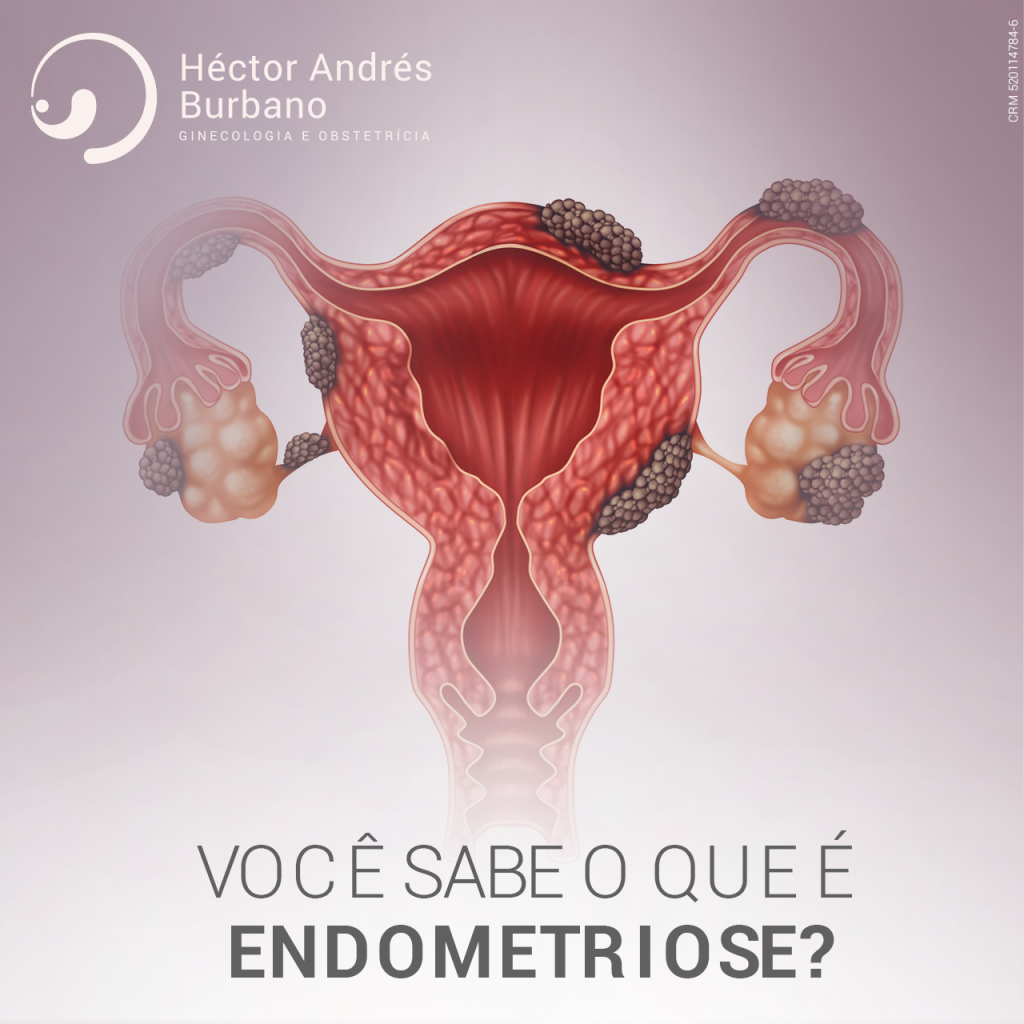 Você Sabe O Que é Endometriose Hector Andres 4408